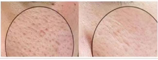 敏感&粉刺&毛孔